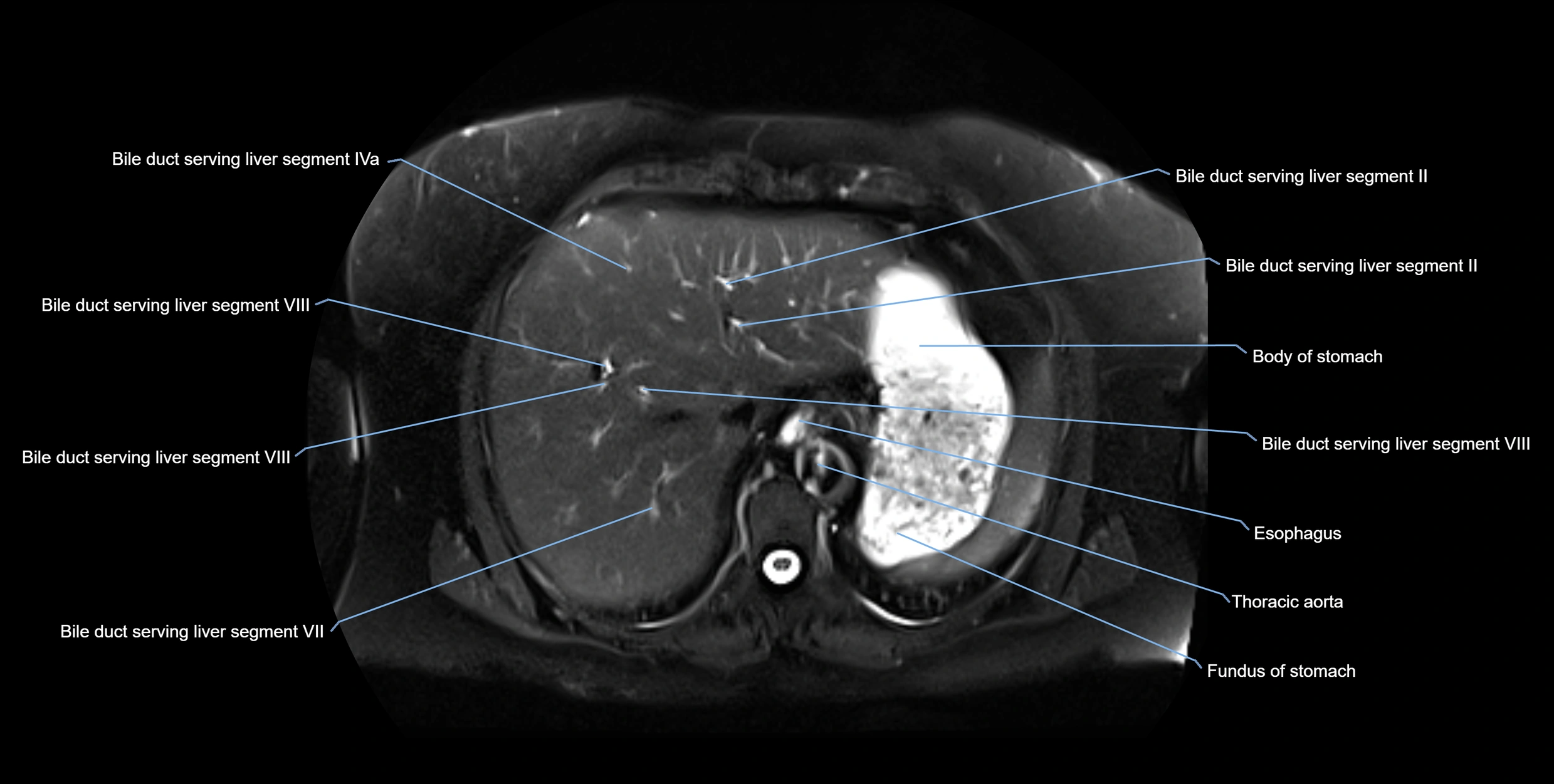 MRI MRCP axial cross sectional anatomy 3T radiology  image-img-10001-00010.webp